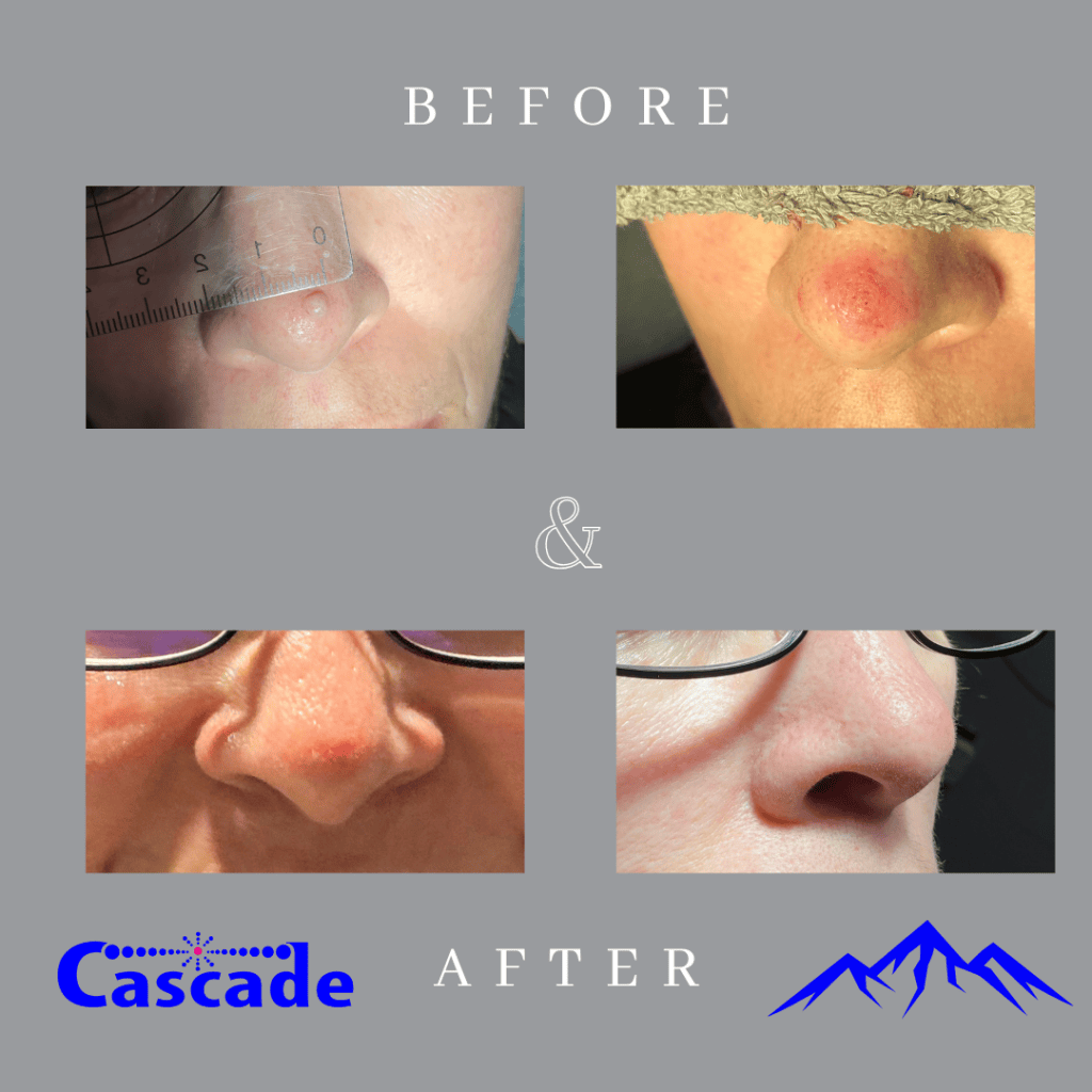 Skin-tag-removal-results-ellman-Portland Real skin tag removal results with Ellman RF Technology at Cascade Medical Spa and Tattoo Removal Center