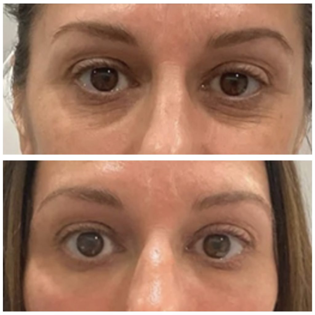 PRP Facial Rejuvenation