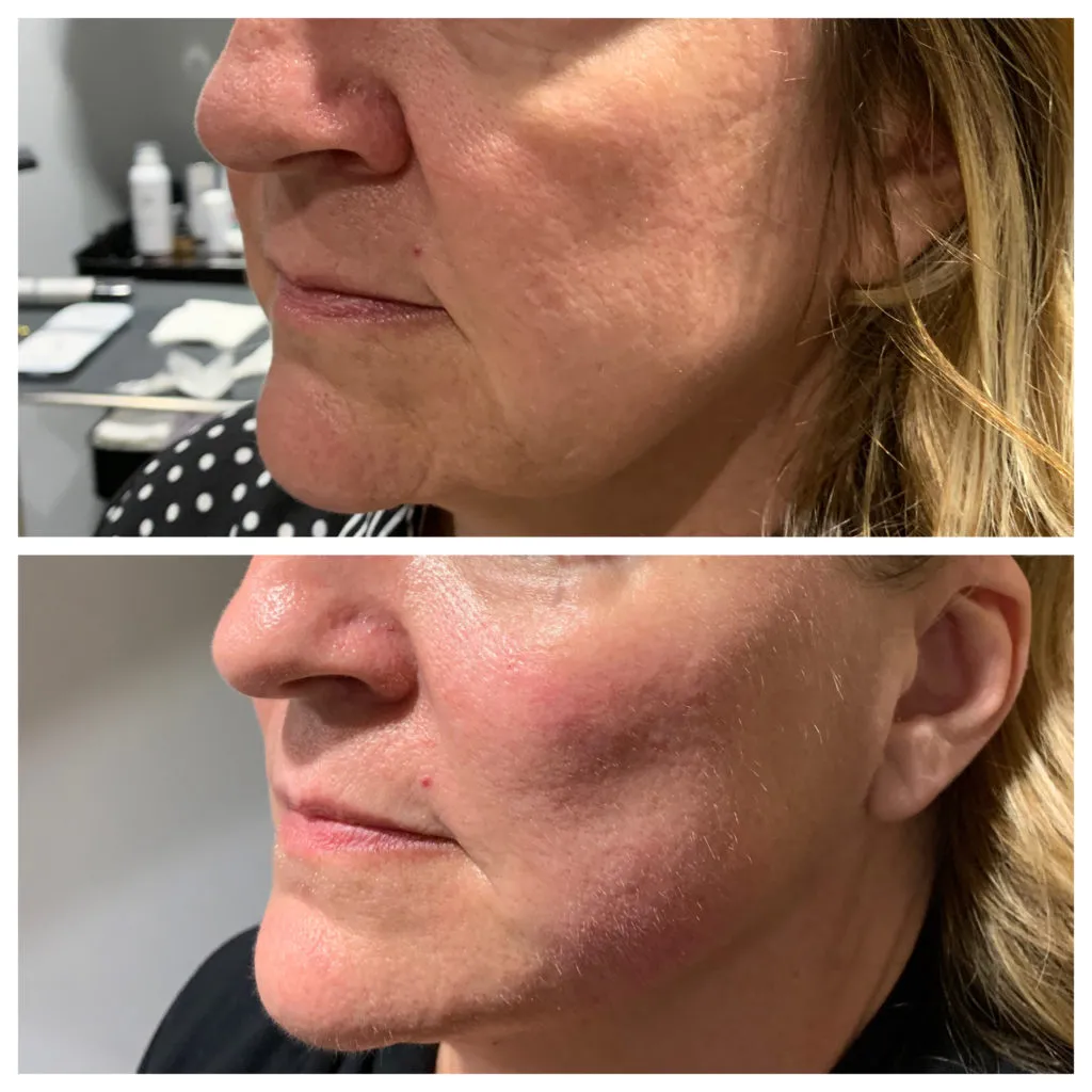 Cheek Filler Portland