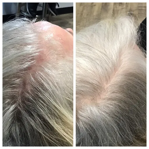 Hair Loss Clinic PRP