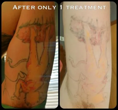 Laser tattoo removal laser tattoo removal