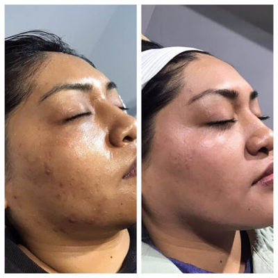 Microneedling PRP for face