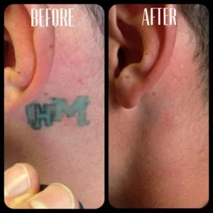 Tattoo Removal laser tattoo removal