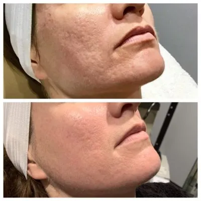Prp Facial with microneedling