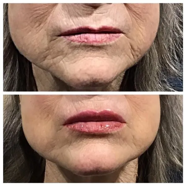 Prp Facial - Lip Fillers