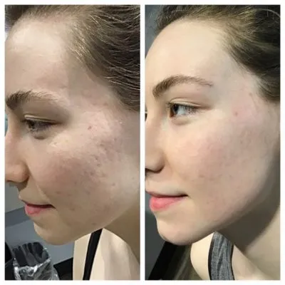 Prp Facial