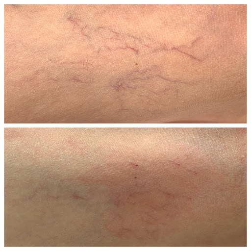 Spider Veins Treatment