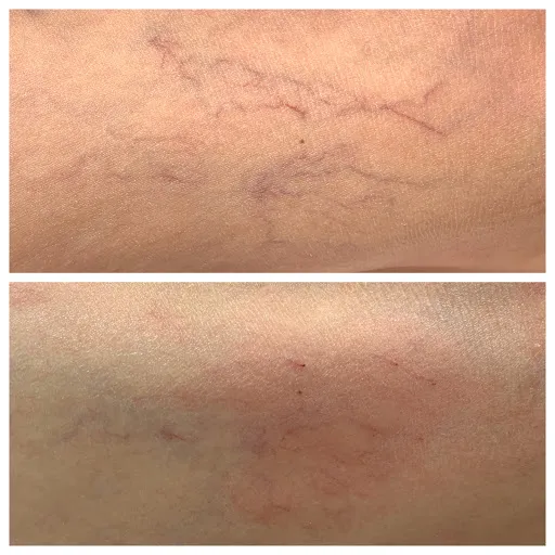 Spider Veins