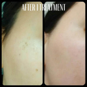 Sun Spot Removal and Melasma