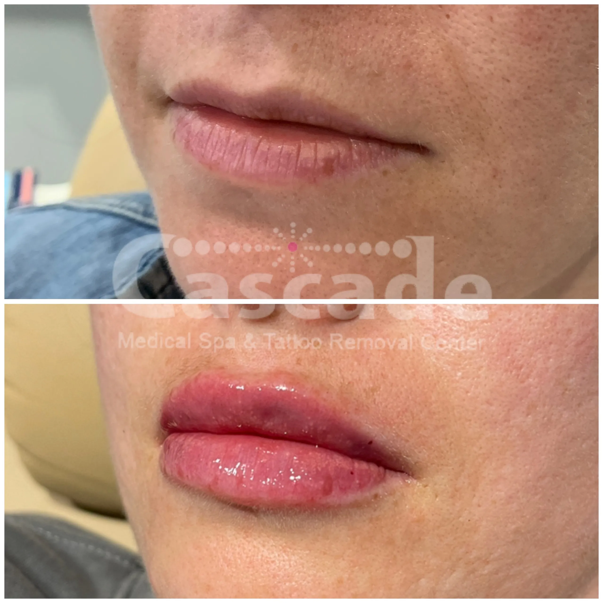 Before and After Photos | Cascade Medical Spa Portland