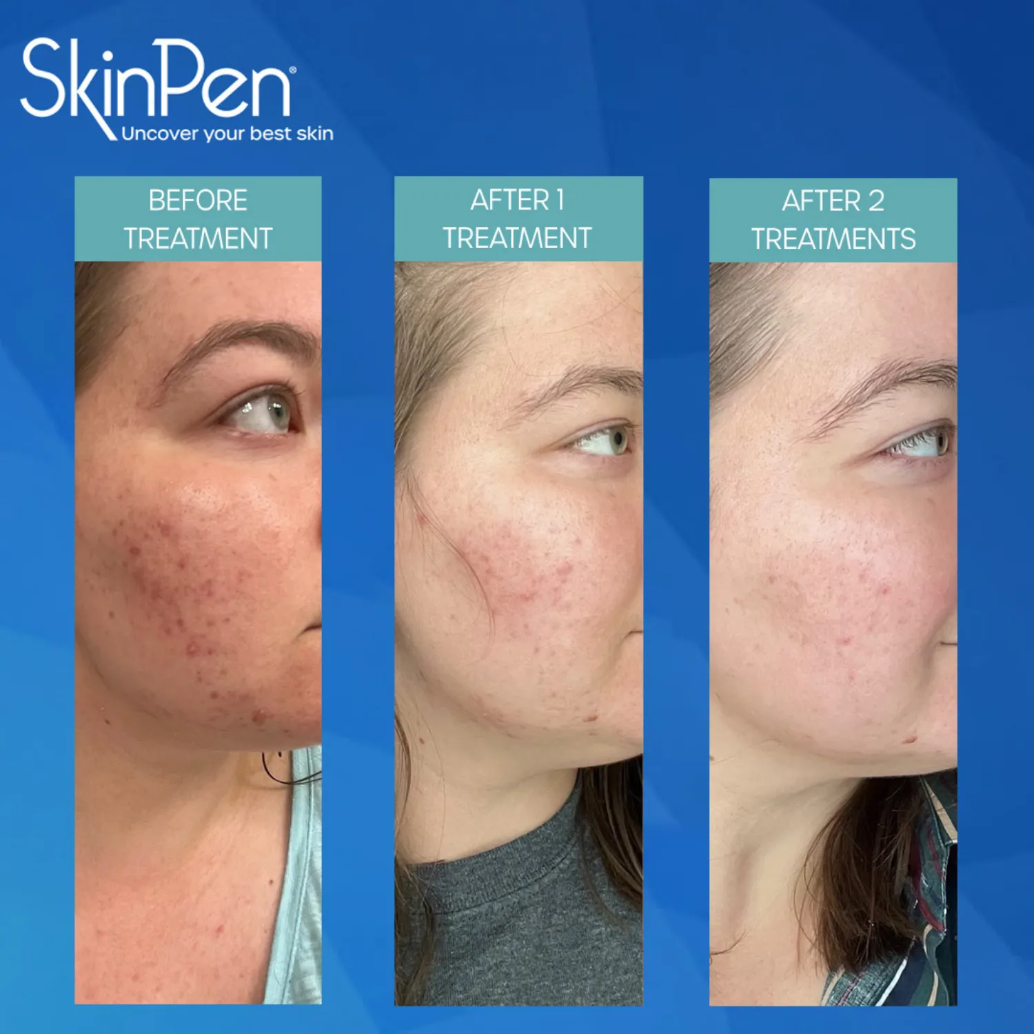SkinPen microneedling before-and-after results after one and two treatments showing improved skin texture and reduced redness at Cascade Medical Spa in Portland.