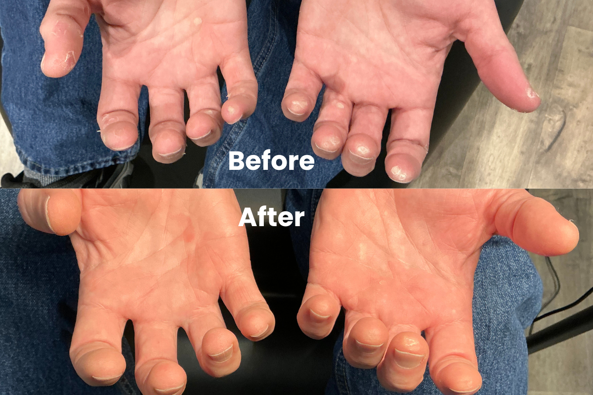 wart removal before and after results in portland