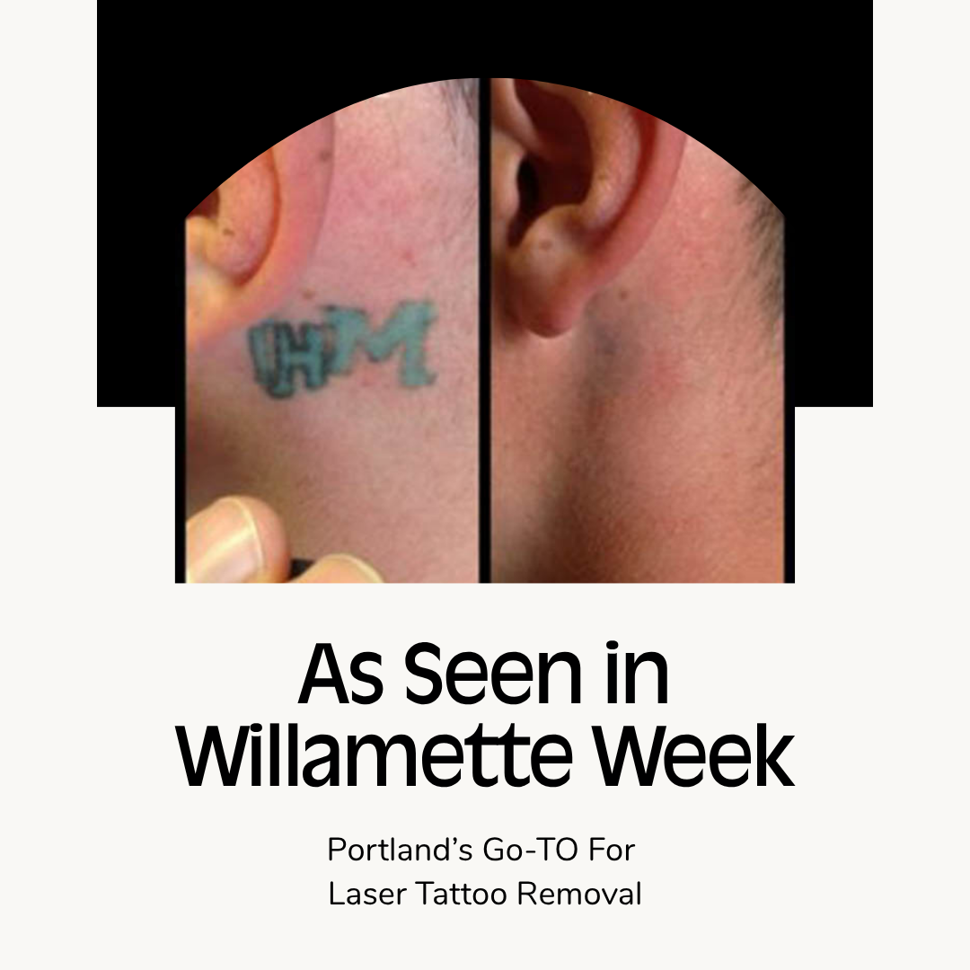 a close-up of a person's before and after blue and green ink tattoo removal