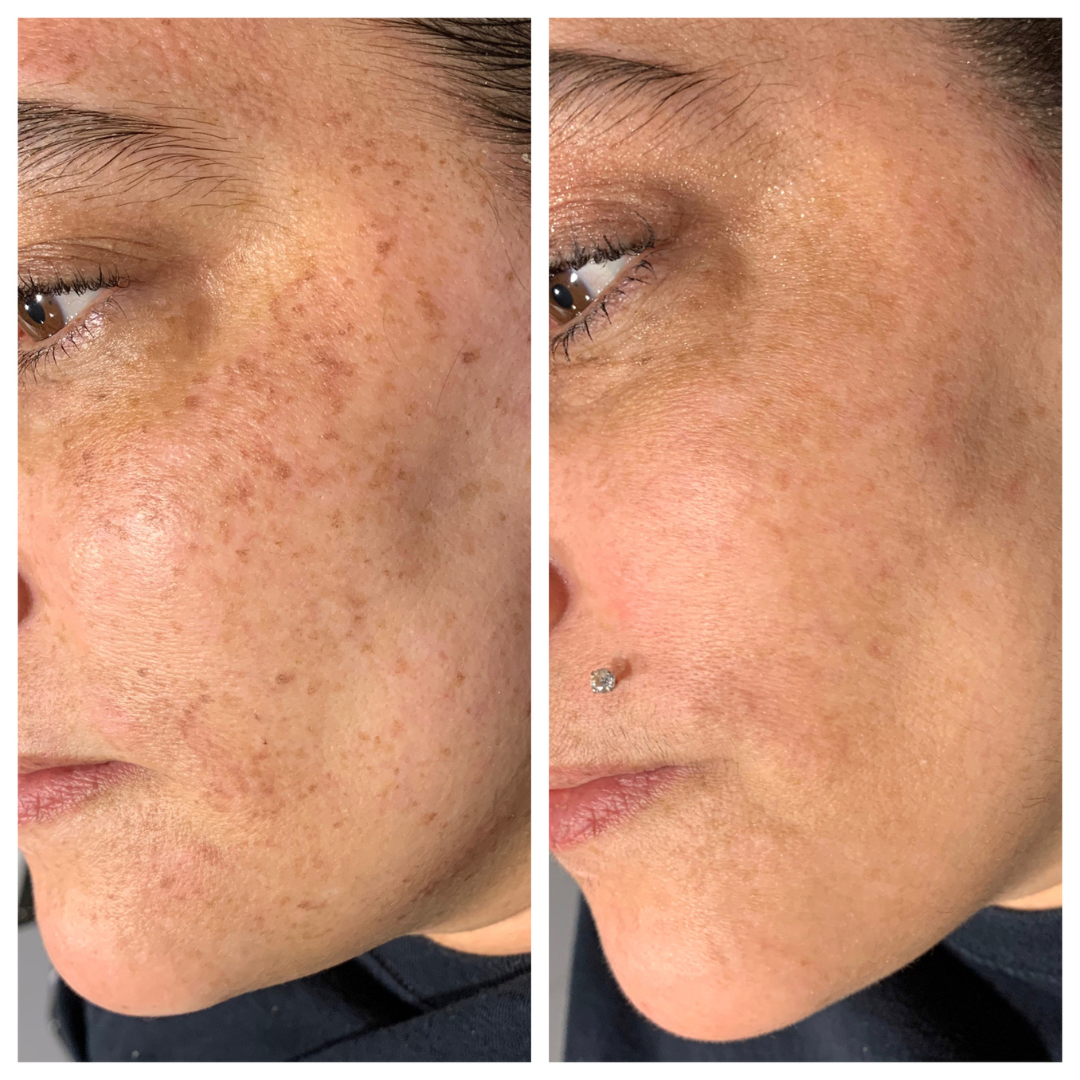 IPl-fotofacial-brown-spots-on-skin-portland
