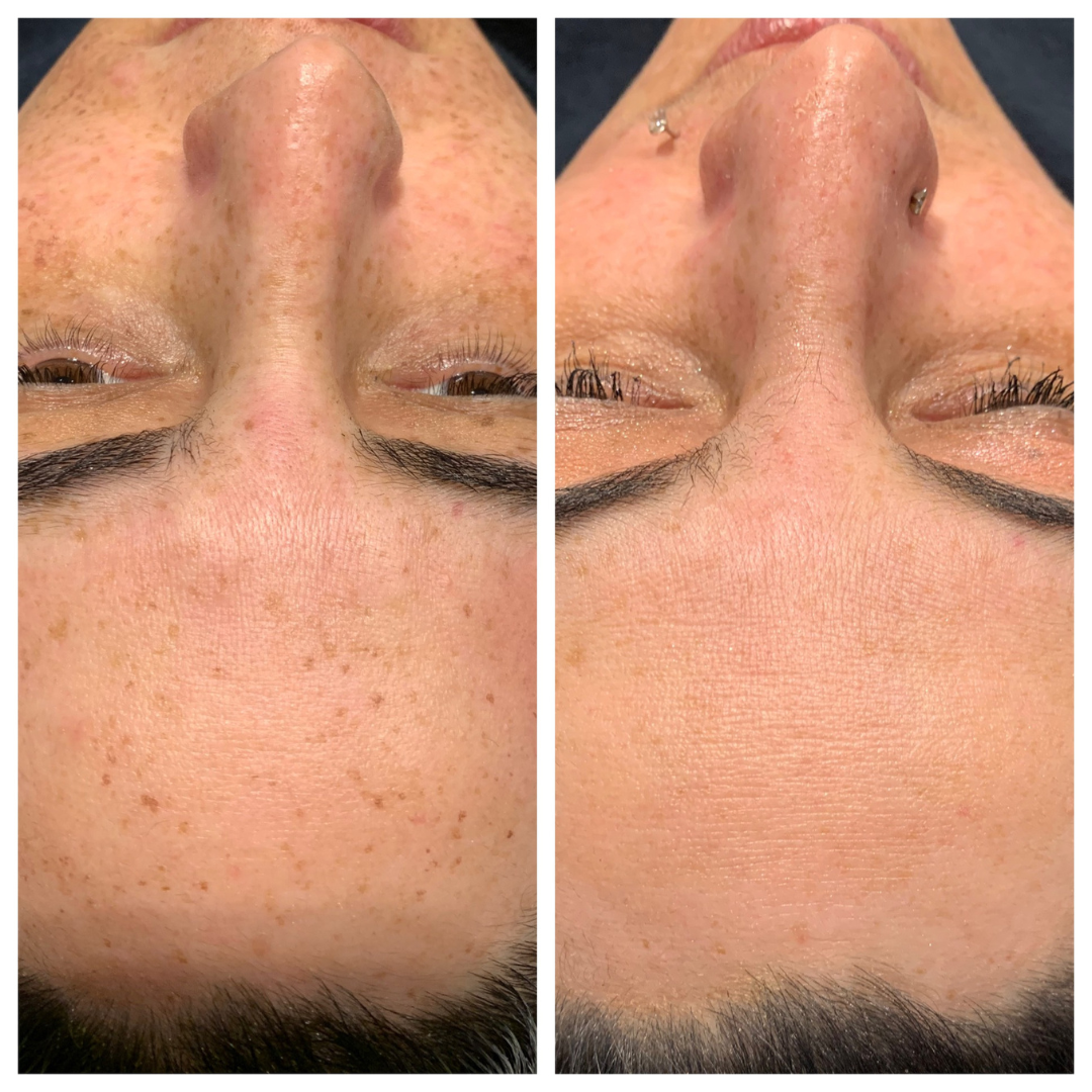 IPL photofacial for spots on skin in portland