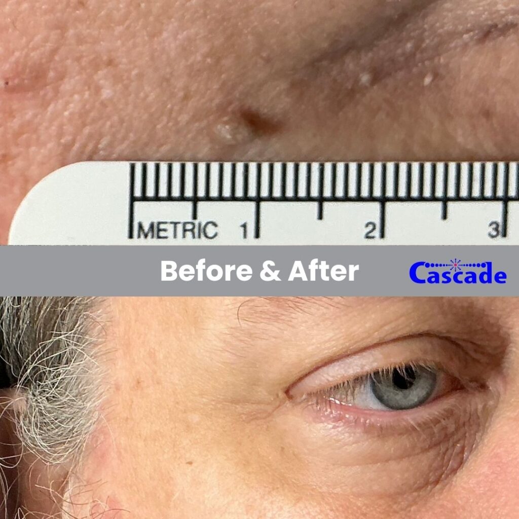 Mole Removal Around Eyes Before & After Mole Removal around eyes with RF technology in Portland Oregon