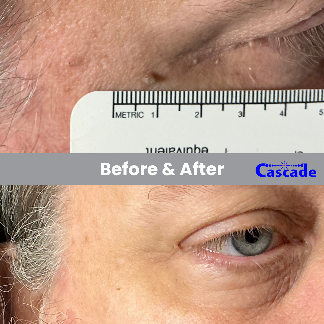 Mole Removal around eyes with RF technology in Portland Oregon