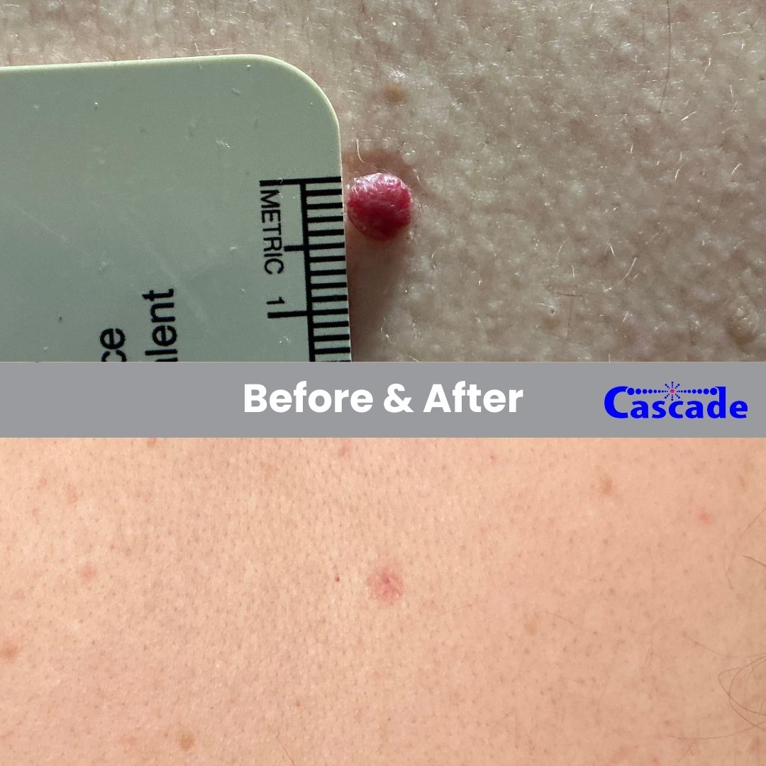 Before and after picture of Skin Tag Removal in Portland Oregon using Radiofrequency technology