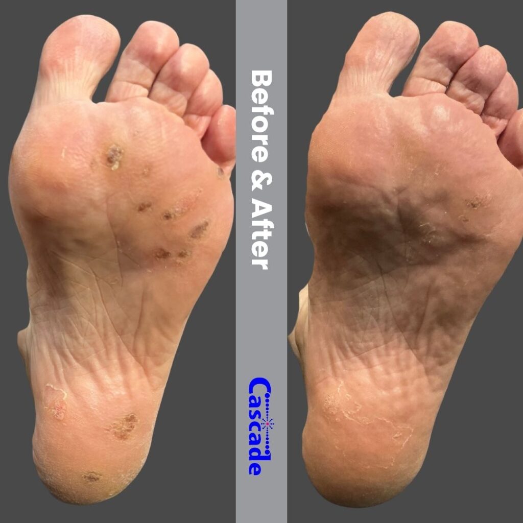 Wart Removal Before & After Portland Wart removal before and after pics with technology with swift.