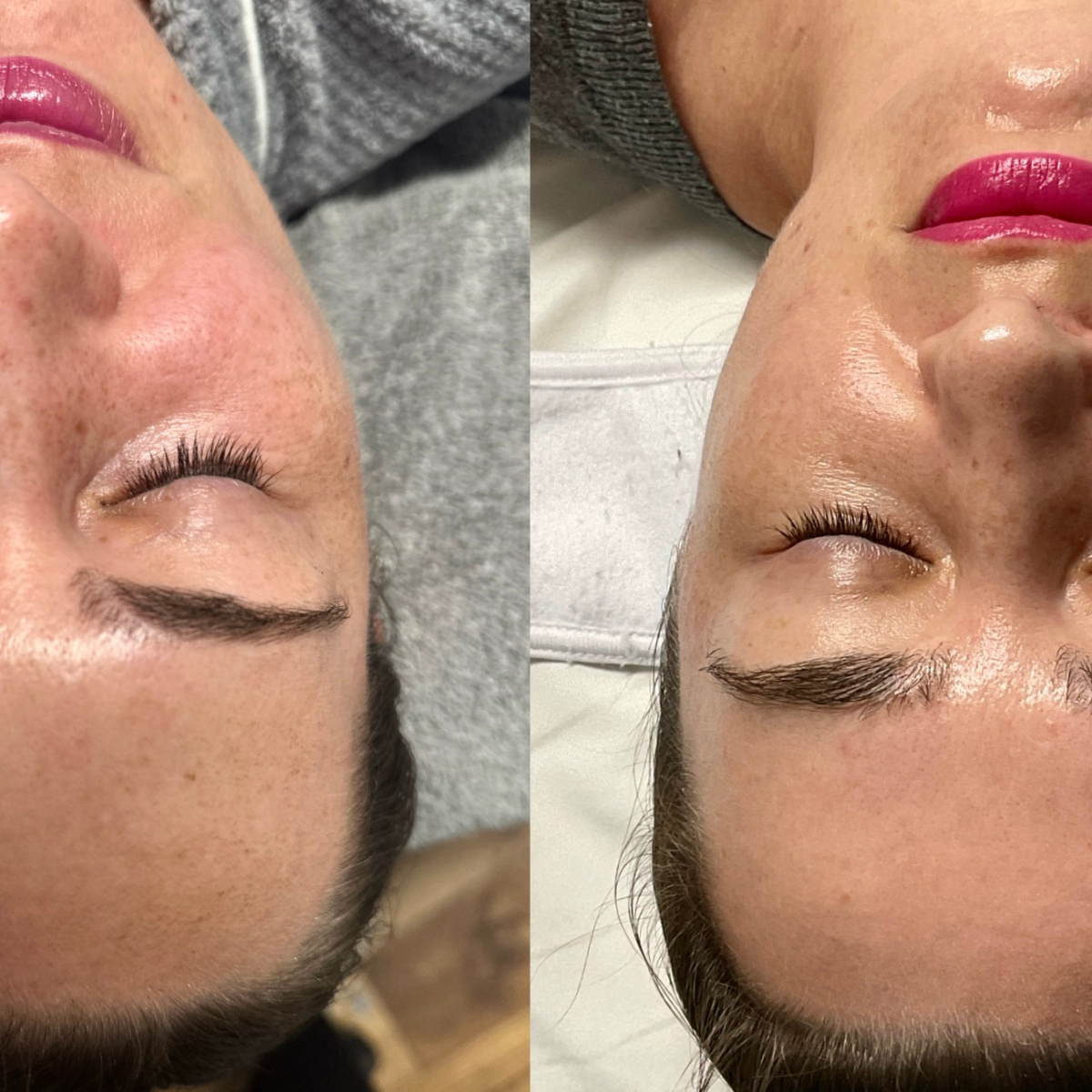 IPL before and after treatments in Portland
