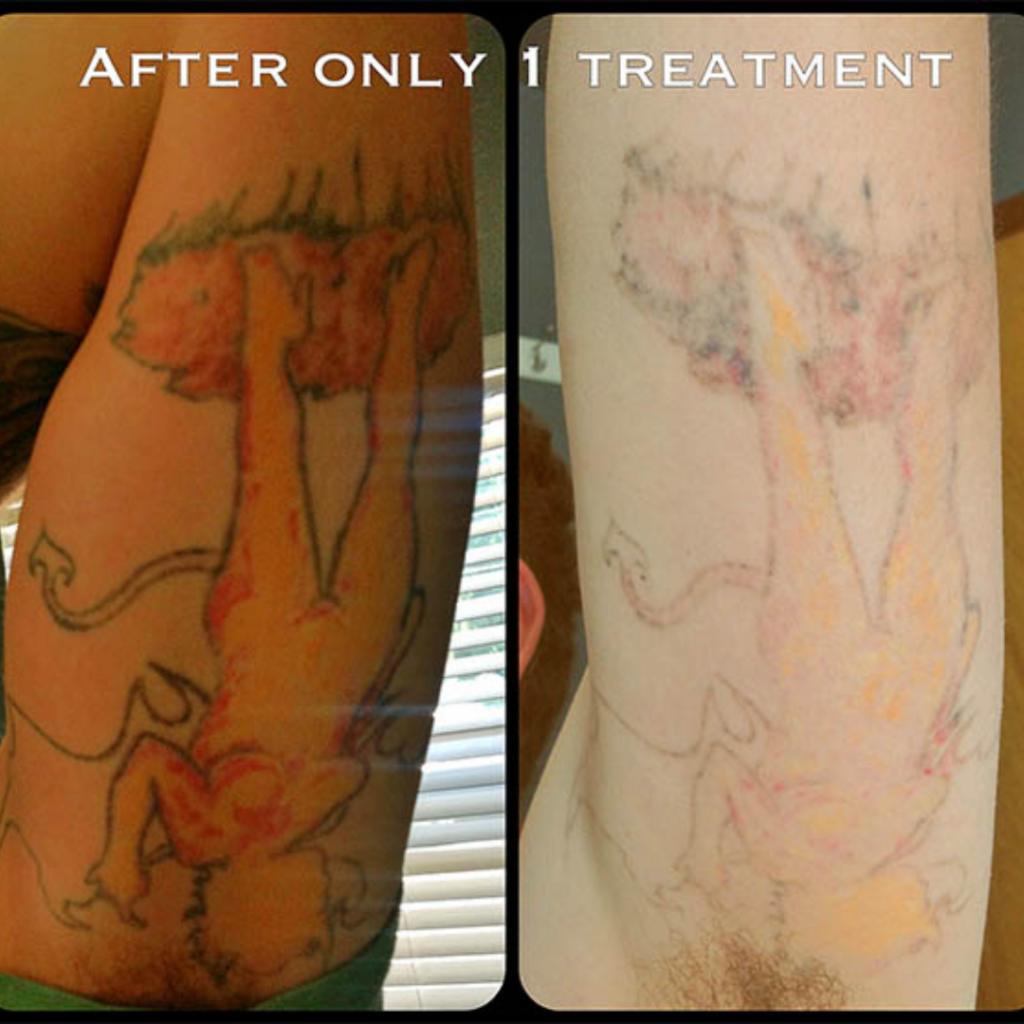 Laser Tattoo removal before and after photo in portland after just one treatment