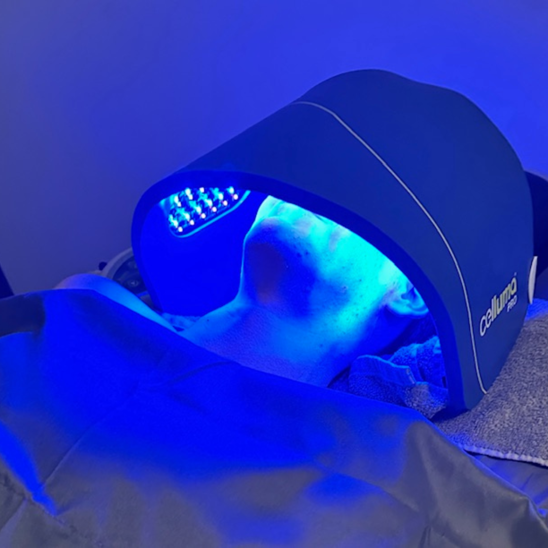 Blue light therapy treatment for acne using Celluma LED device at Cascade Medical Spa in Portland.
