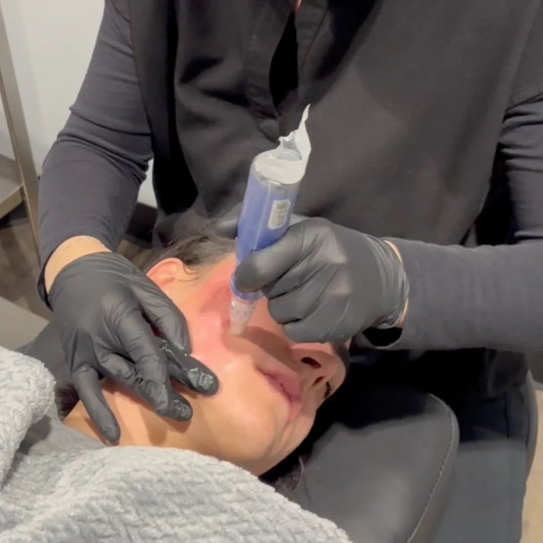 PRP Facial Rejuvenation