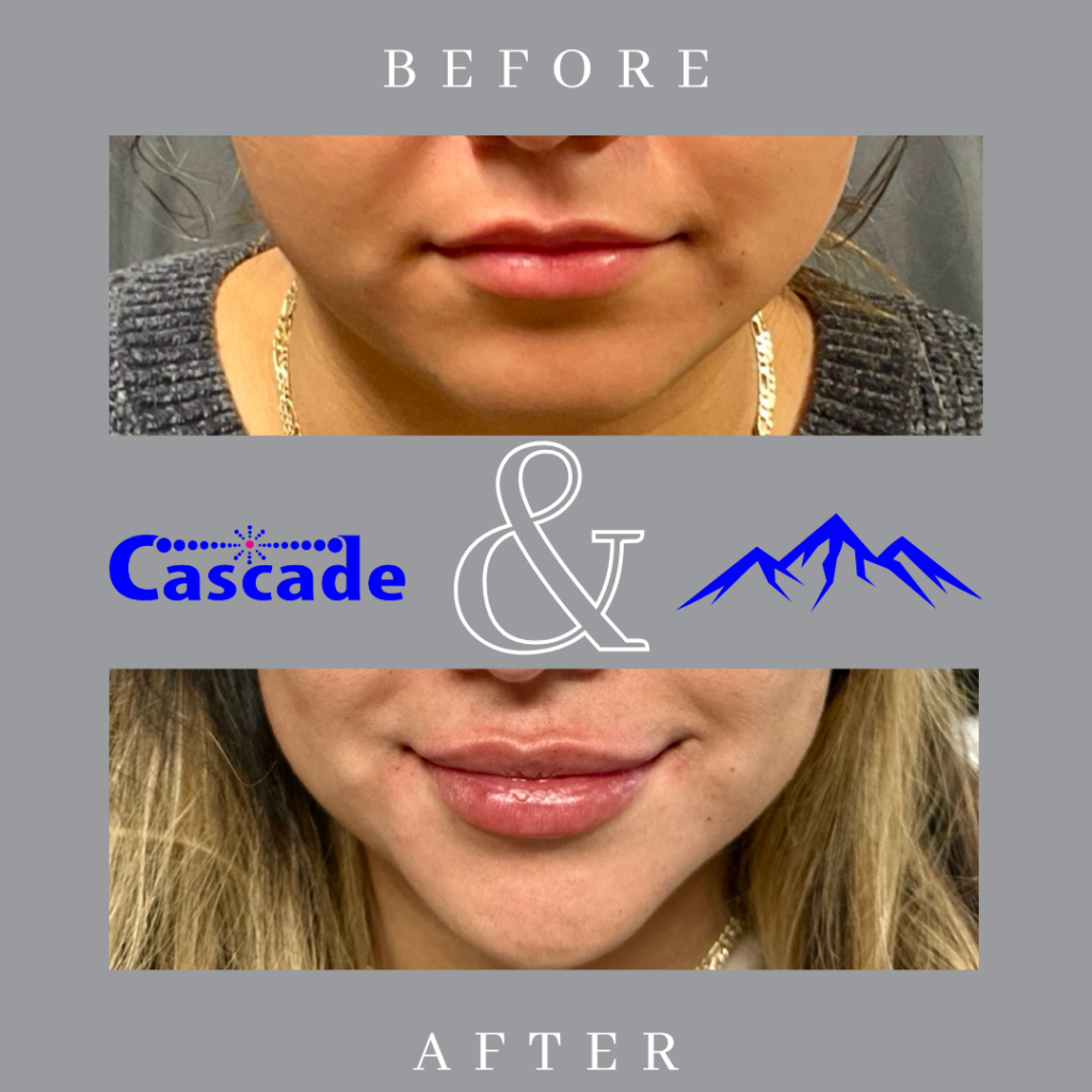 Lip filler before and after results at Cascade Medical Spa in Portland showing enhanced lip volume and natural definition.