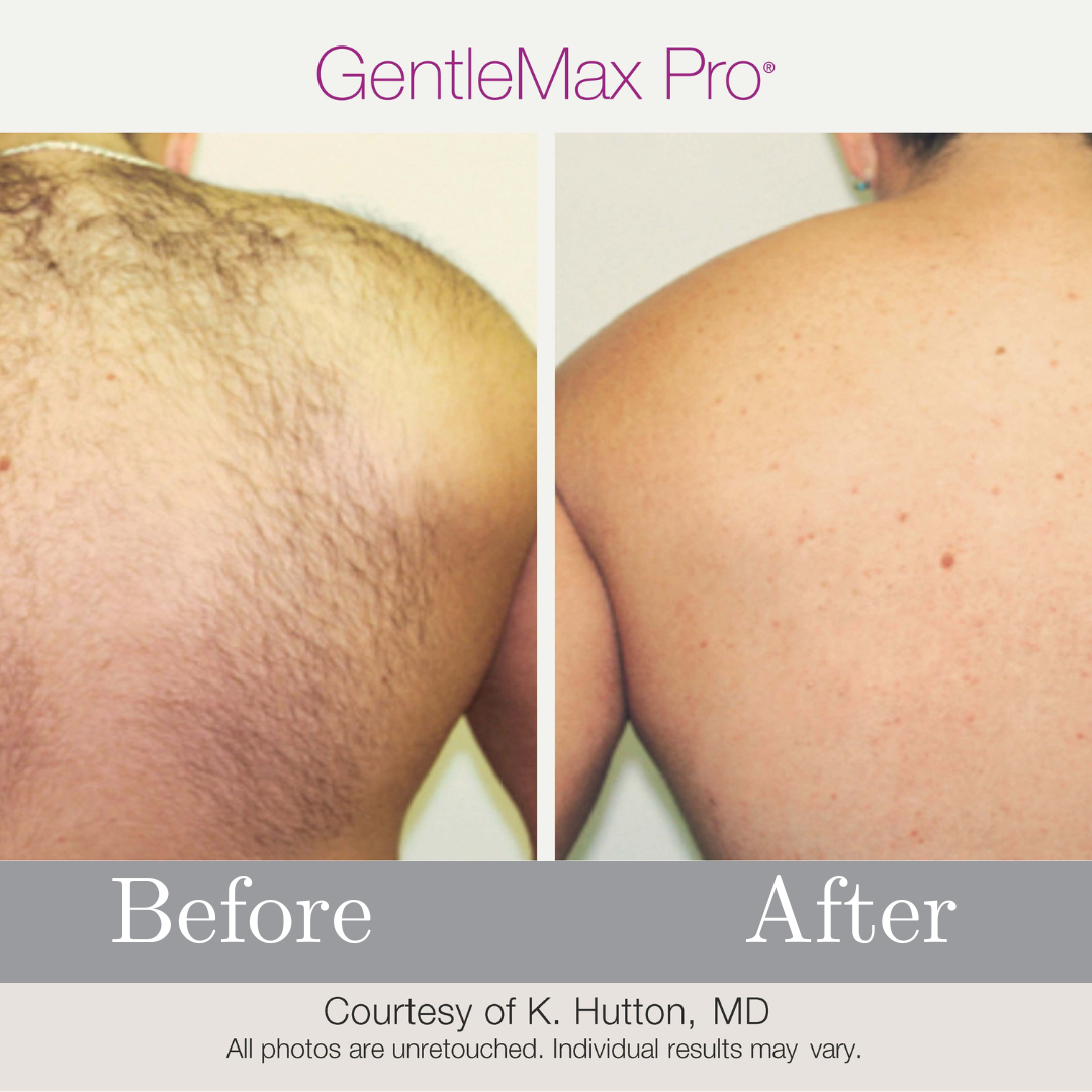 Upper Back Laser Hair Removal Results – GentleMax Pro | Cascade Medical Spa Portland Laser hair removal before and after on upper back using GentleMax Pro at Cascade Medical Spa in Portland.