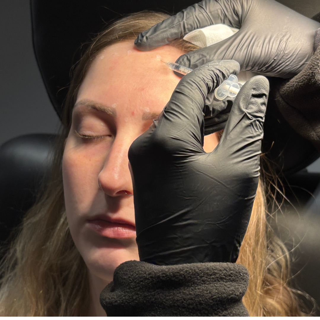 Wrinkle relaxer forehead injection performed by a licensed injector at Cascade Medical Spa in Portland.