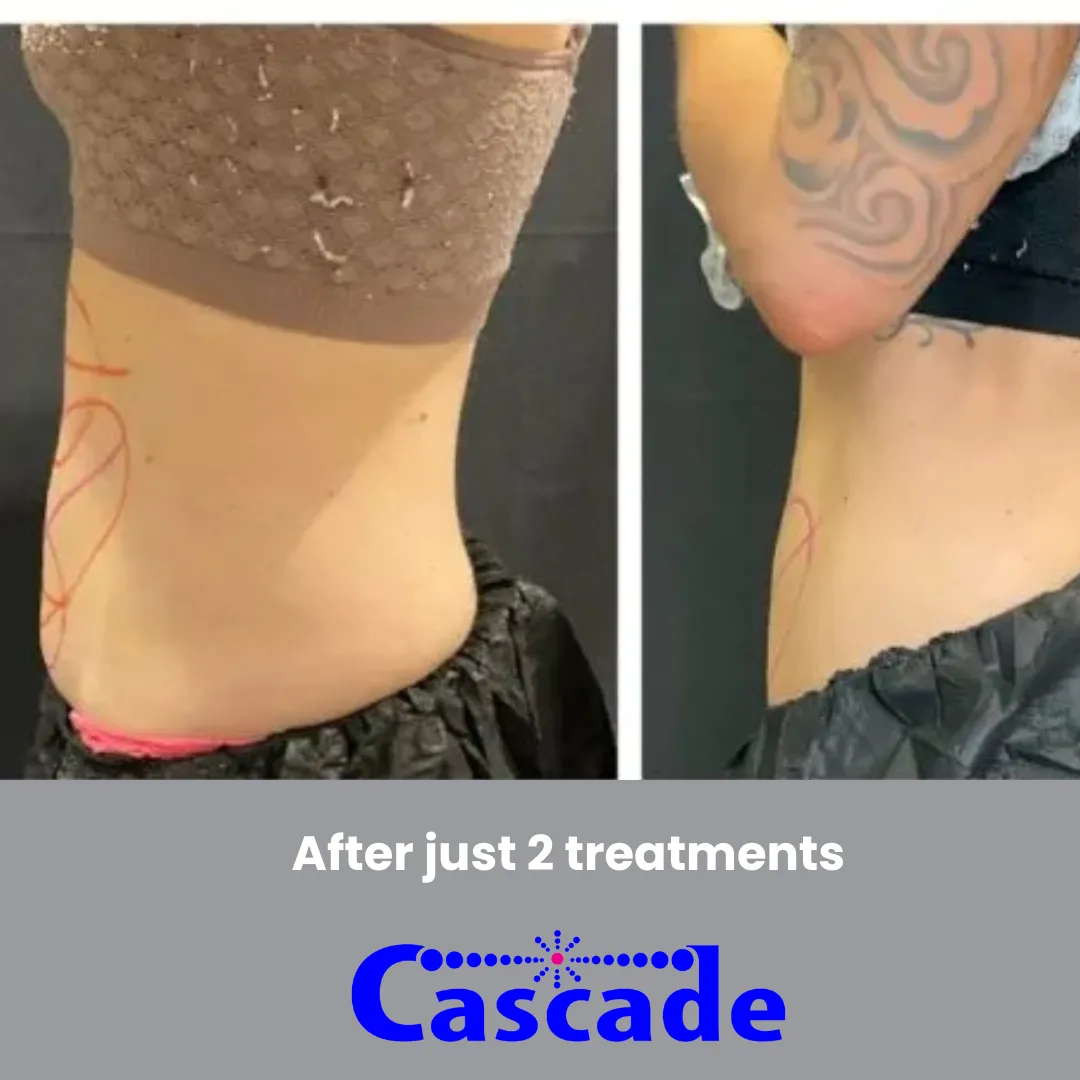 Coolsculpting
