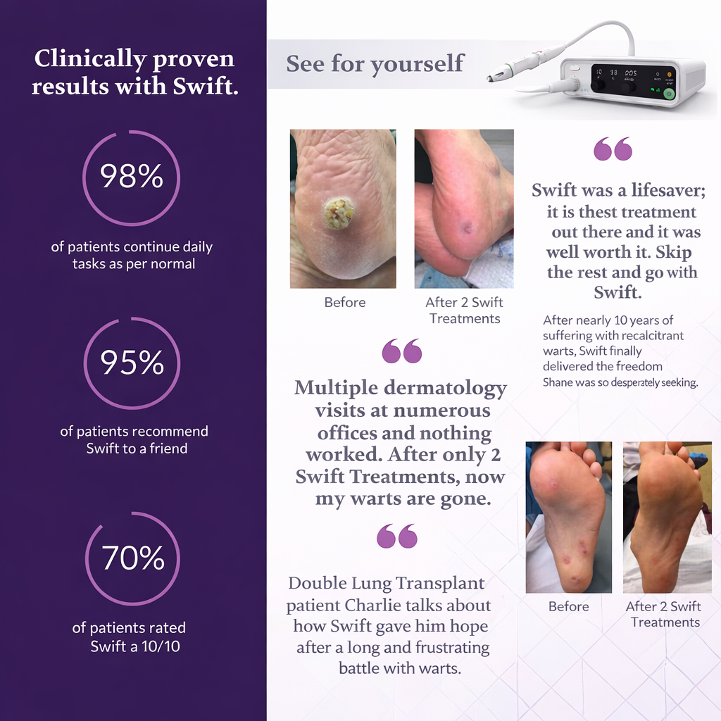 Plantar Wart Removal Portland – Swift Microwave Therapy Results Advanced plantar wart removal in Portland using Swift microwave therapy before and after results
