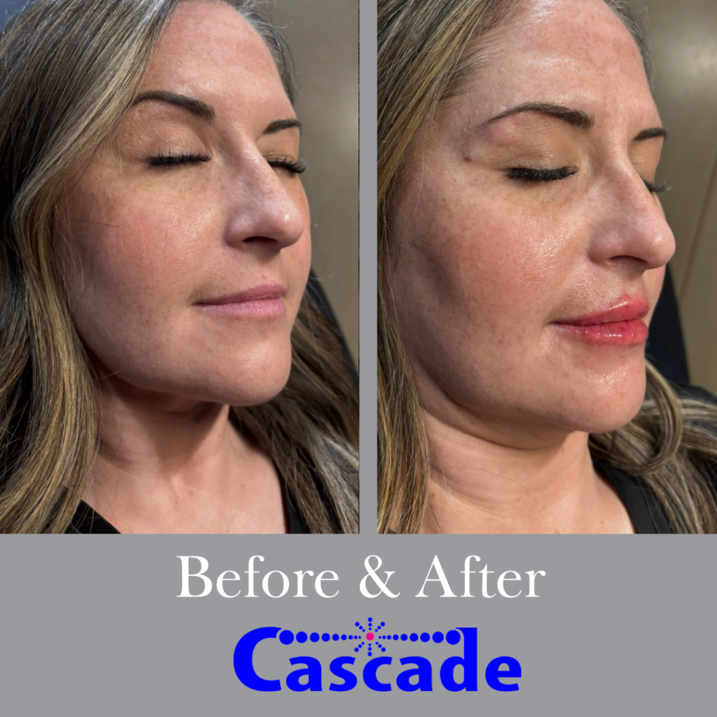 Lip-fillers-before-after-portland lip filler before and after results with RHA lip filler