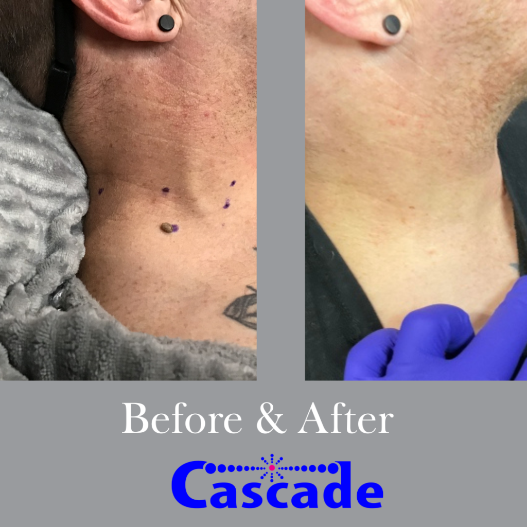 Mole Removal Cascade Medical Spa- Portland Mole removal treatment on neck using radio frequency