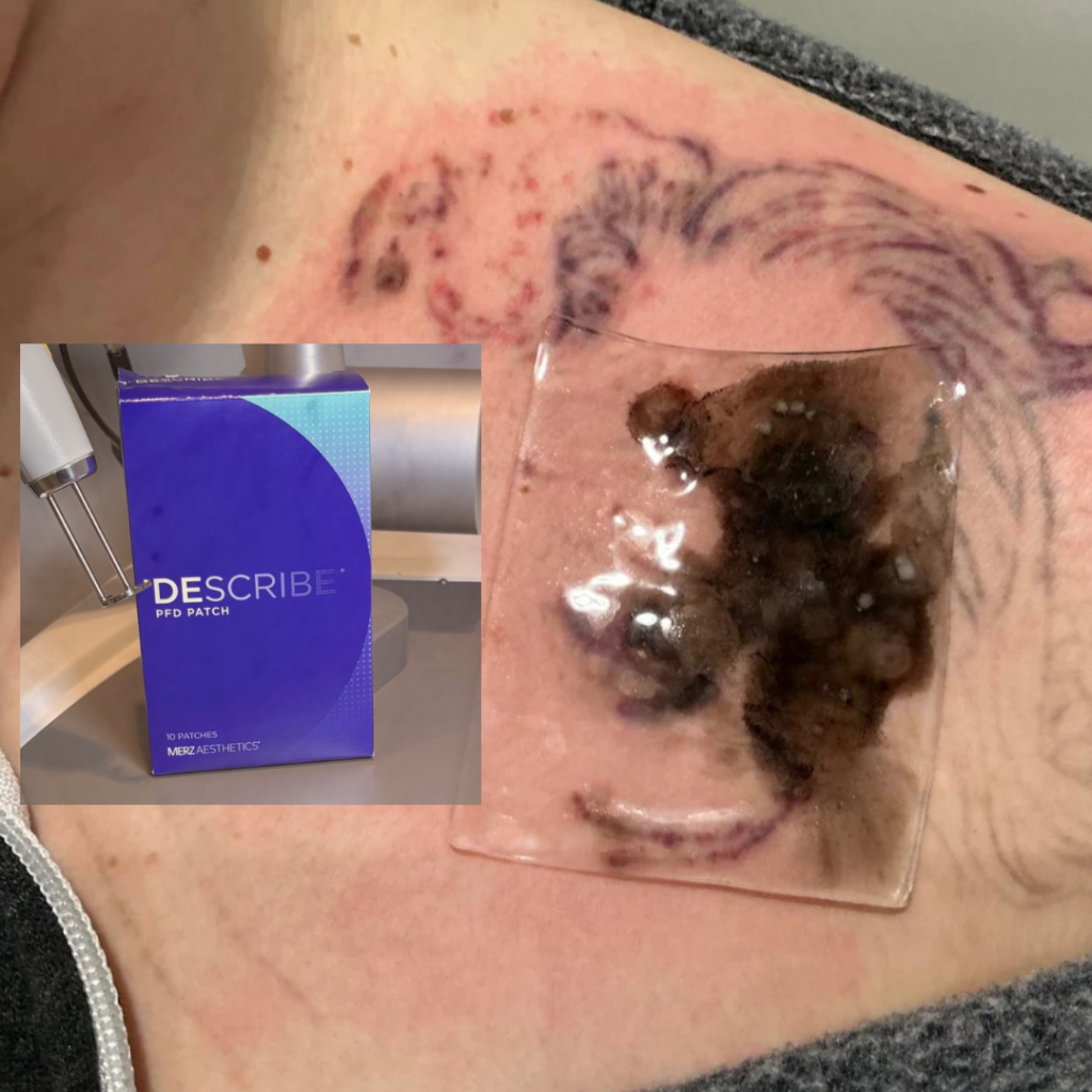 PFD-patch-laser-tattoo-removal-portland (1) PFD Patch laser tattoo removal ink fading out