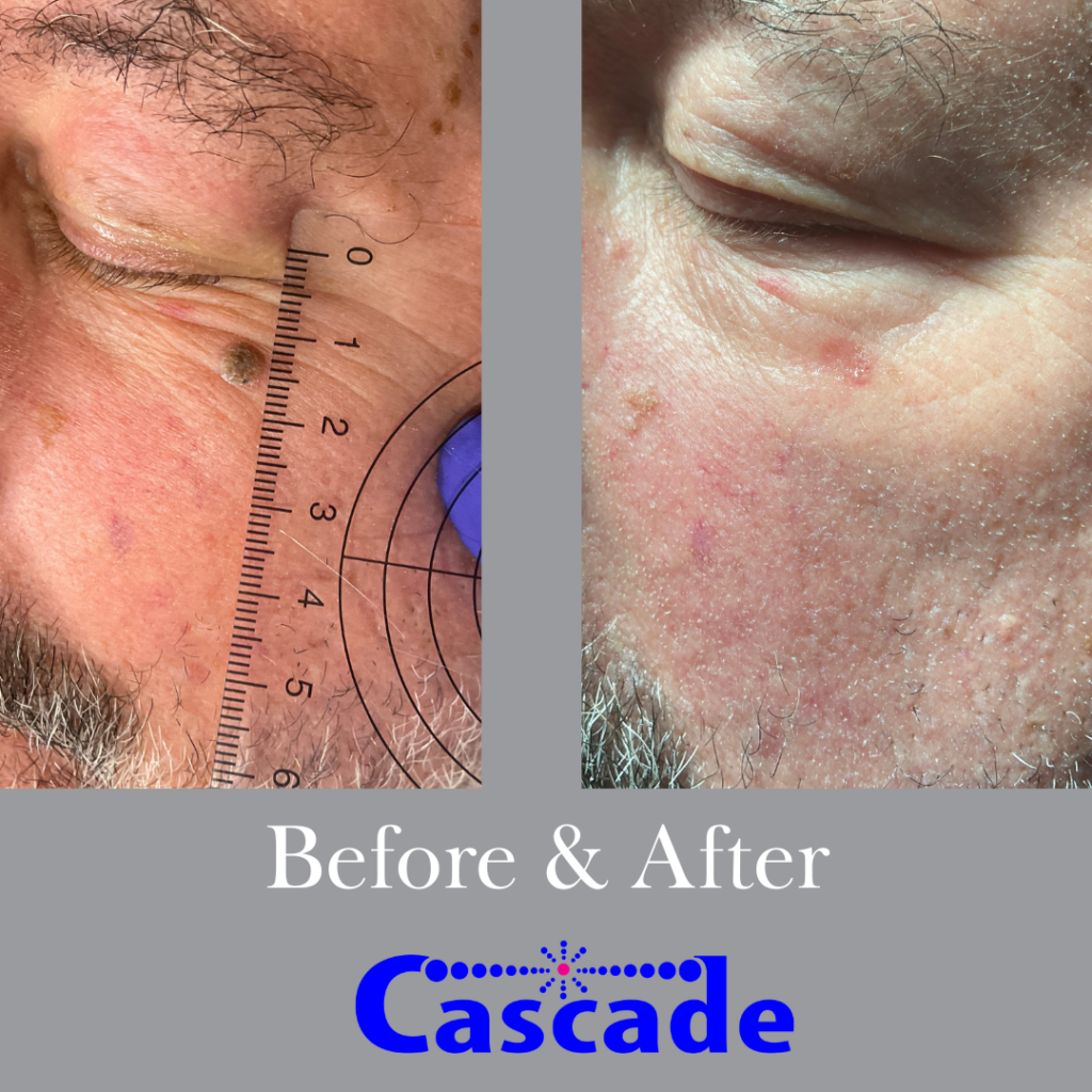 mole removal