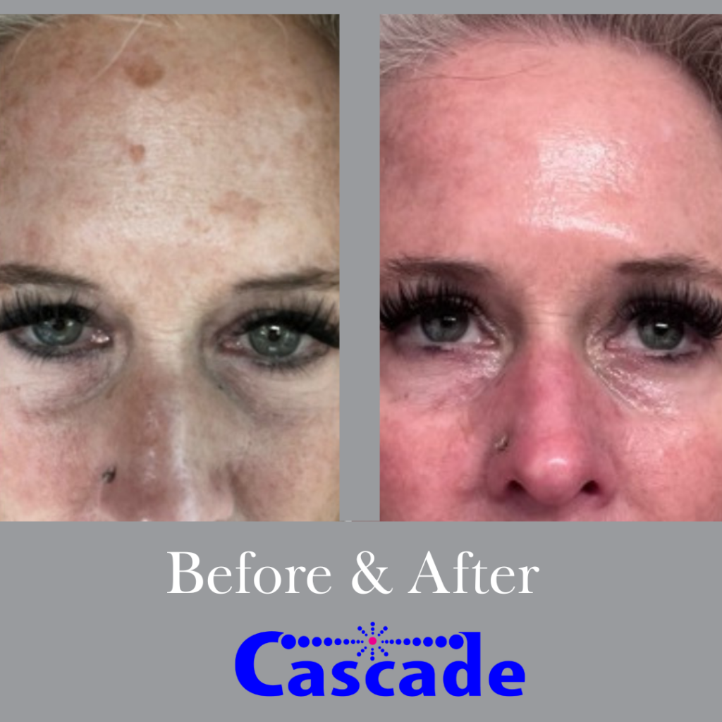 Skin Discoloration