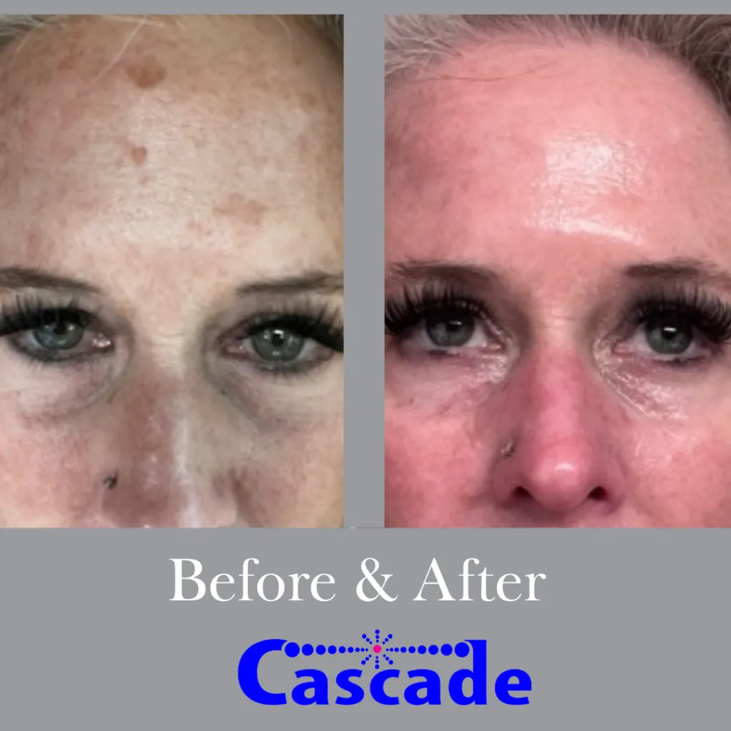 Skin Discoloration