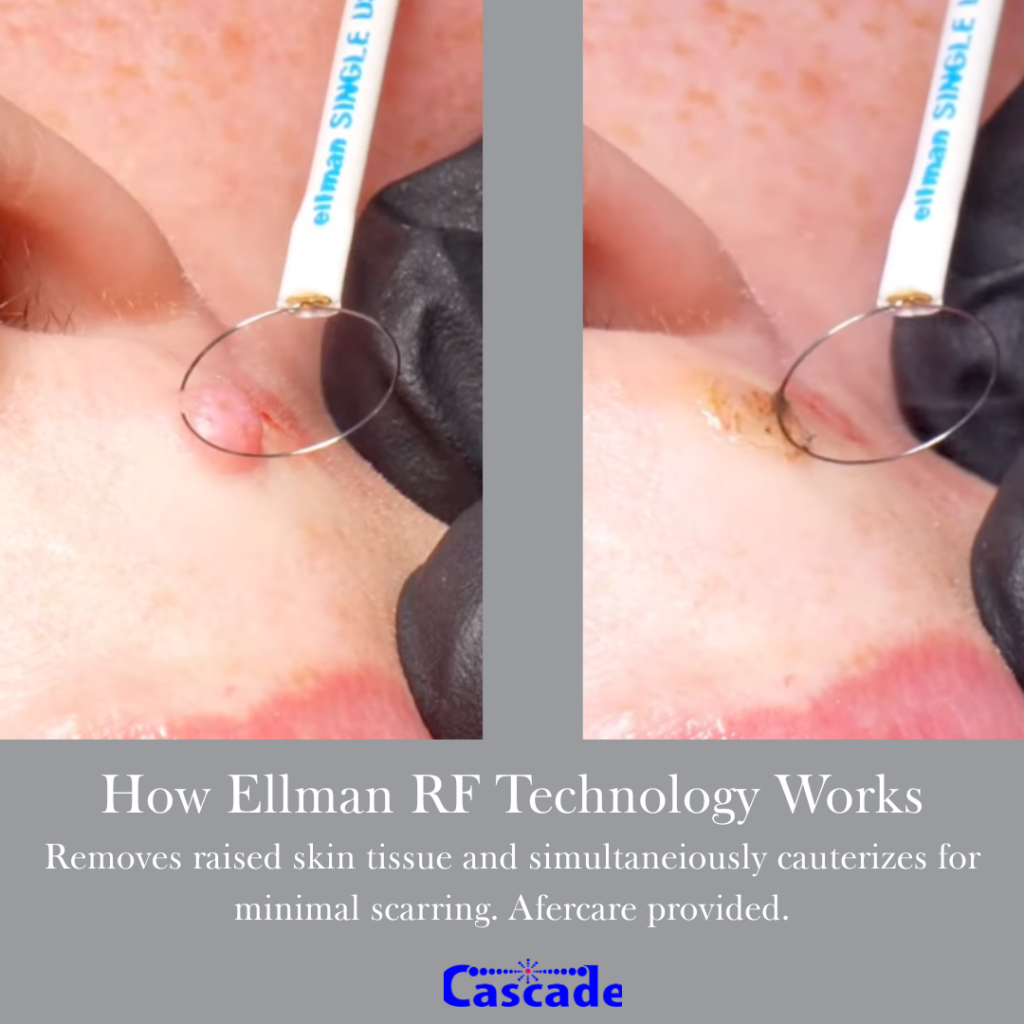 How-mole-and-skin-tag-removal-works- Portland How mole and skin tag removal works in portland
