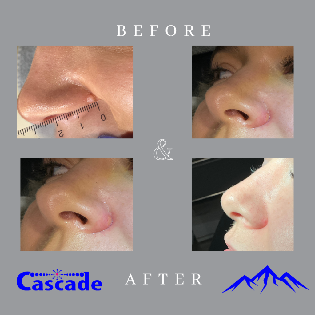 Skin-tag-on-nose-removal-results-ellman-Portland Skin tag removal on nose before and after results in Portland at Cascade Medical Spa and Tattoo Removal Center