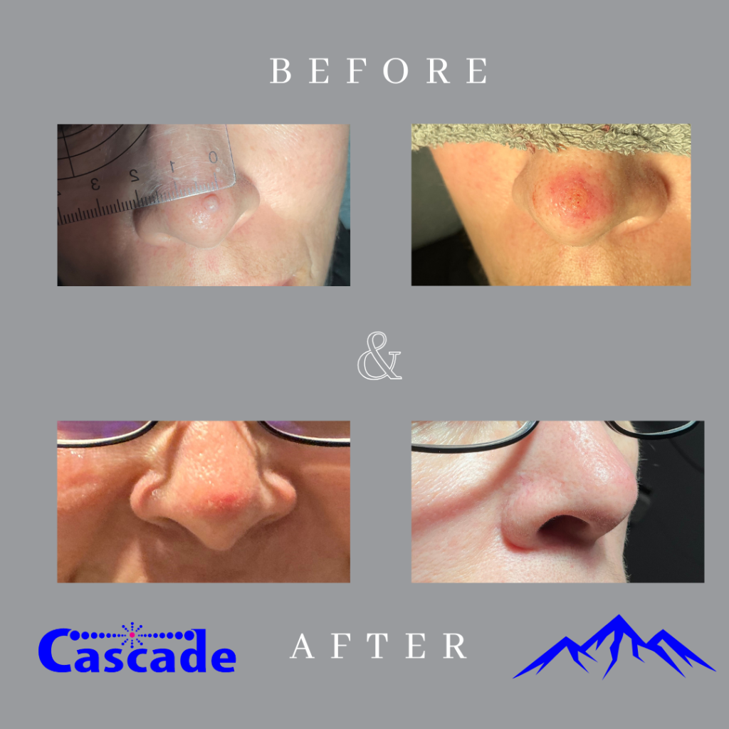 Skin-tag-removal-results-ellman-Portland Real skin tag removal results with Ellman RF Technology at Cascade Medical Spa and Tattoo Removal Center