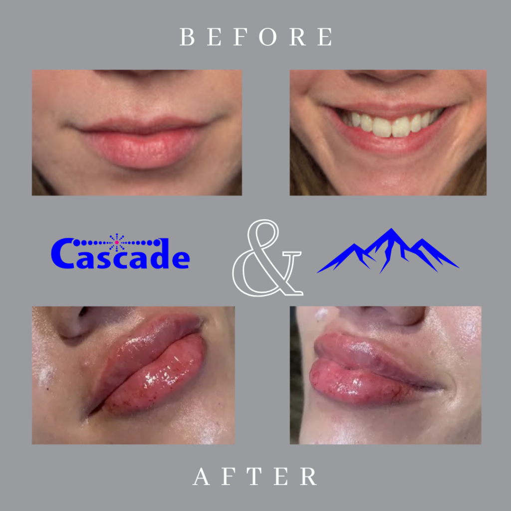 Lip Filler before and after results with RHA in Portland